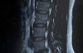脊柱管正作症
